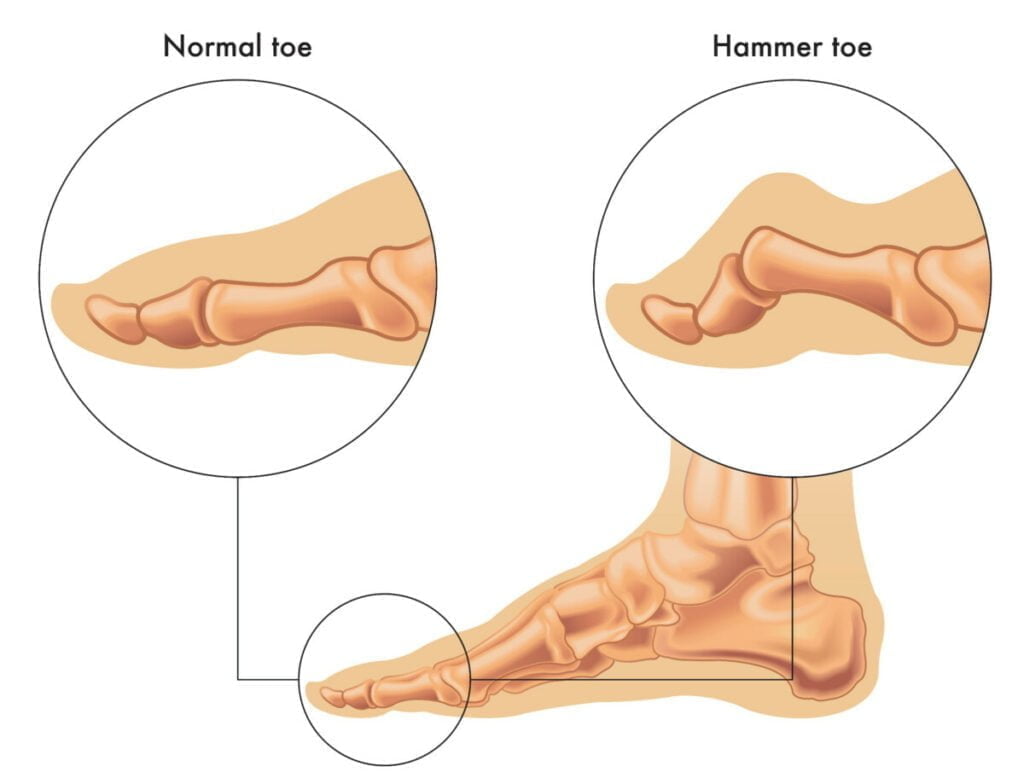 Hamertenen – kromme tenen en behandeling