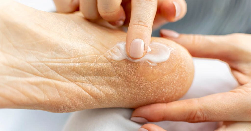 Fersensprünge behandeln – hydratisieren und Hornhaut entfernen