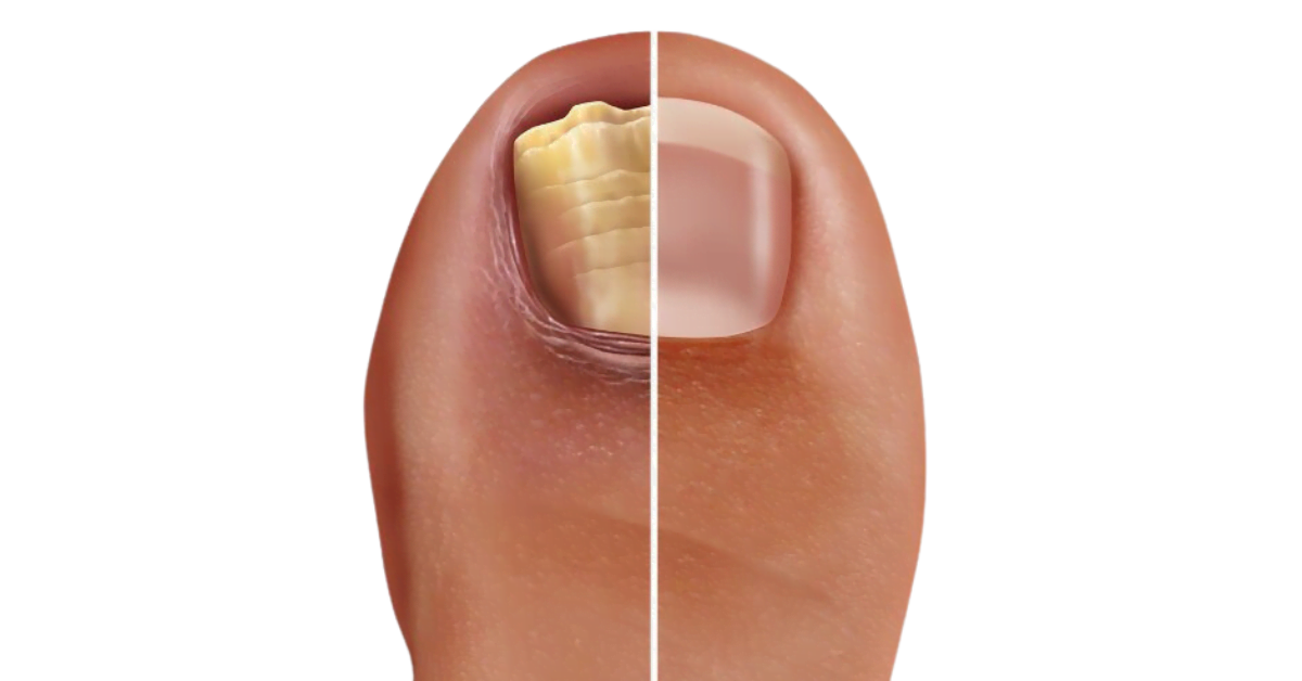 Nagelpilz am Zeh
